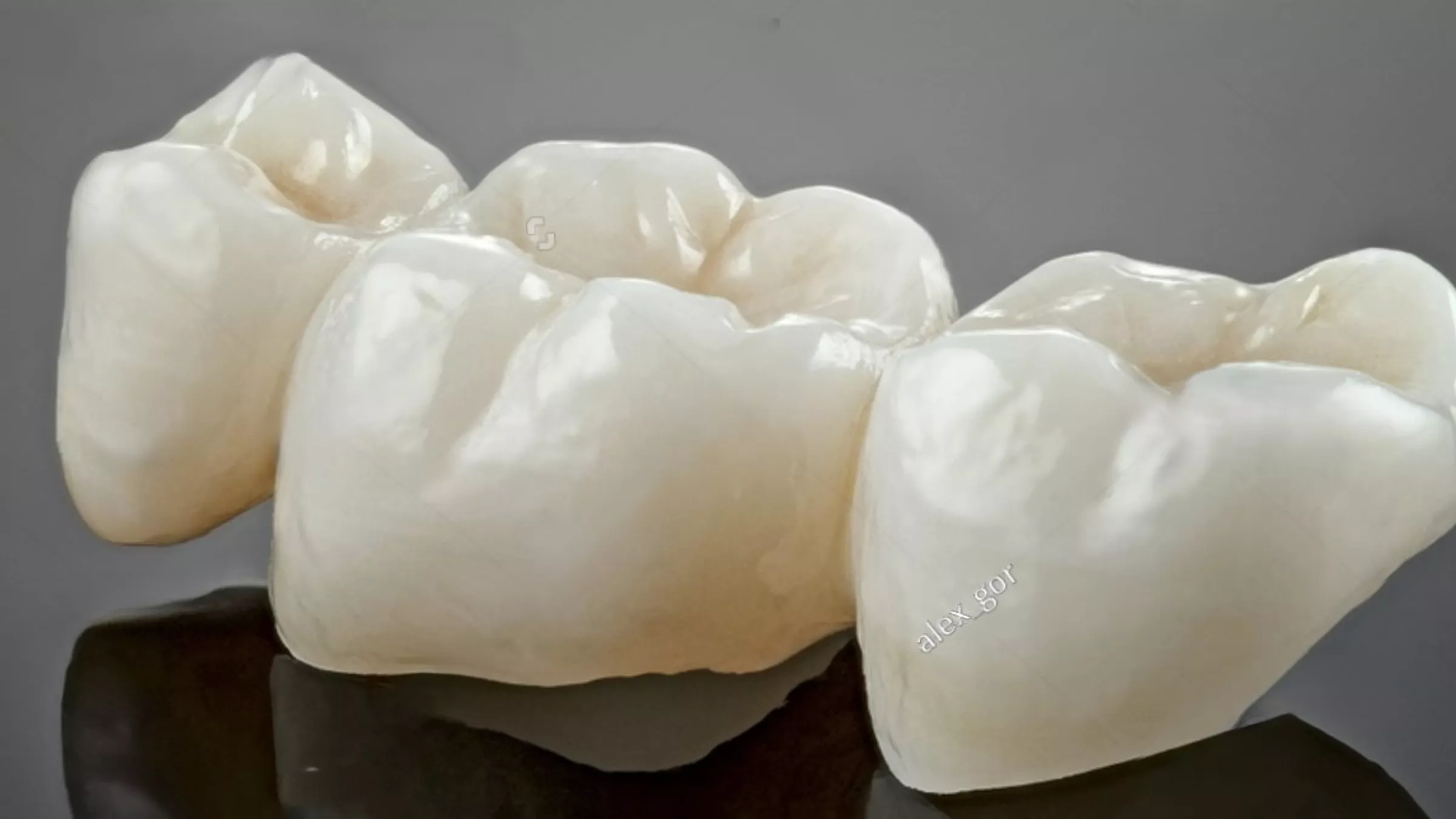 pont dentaire de 3 dents