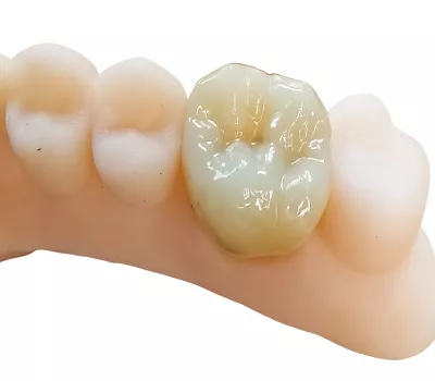 couronne molaire sur modèle