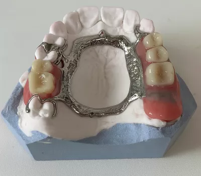 prothèse amovible stellite sur modèle