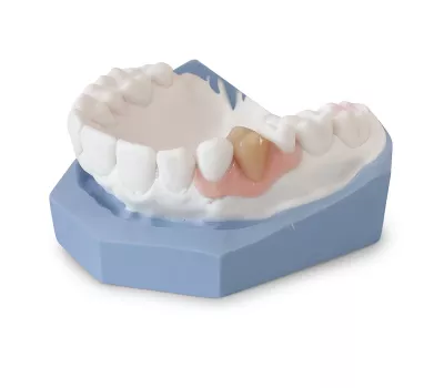 prothèse valplast sur modèle