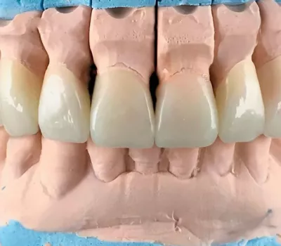 Insicives en céramique sur modèle