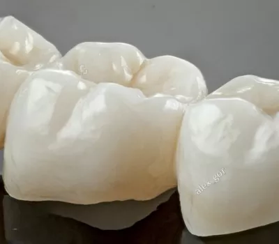 pont zircone postérieur