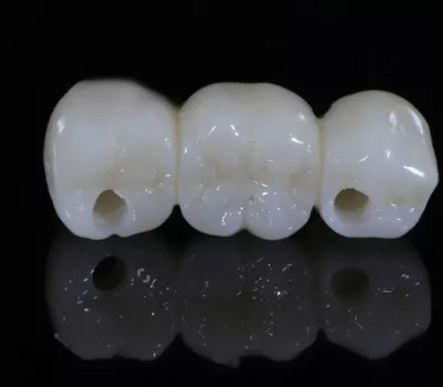 pont zircon transvissé sur implant