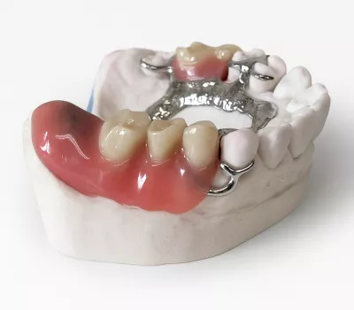 prothèse amovible stellite sur modèle