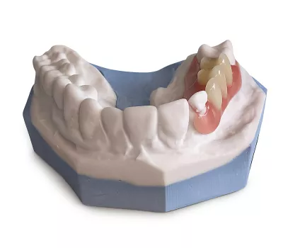 prothèse valplast sur modèle